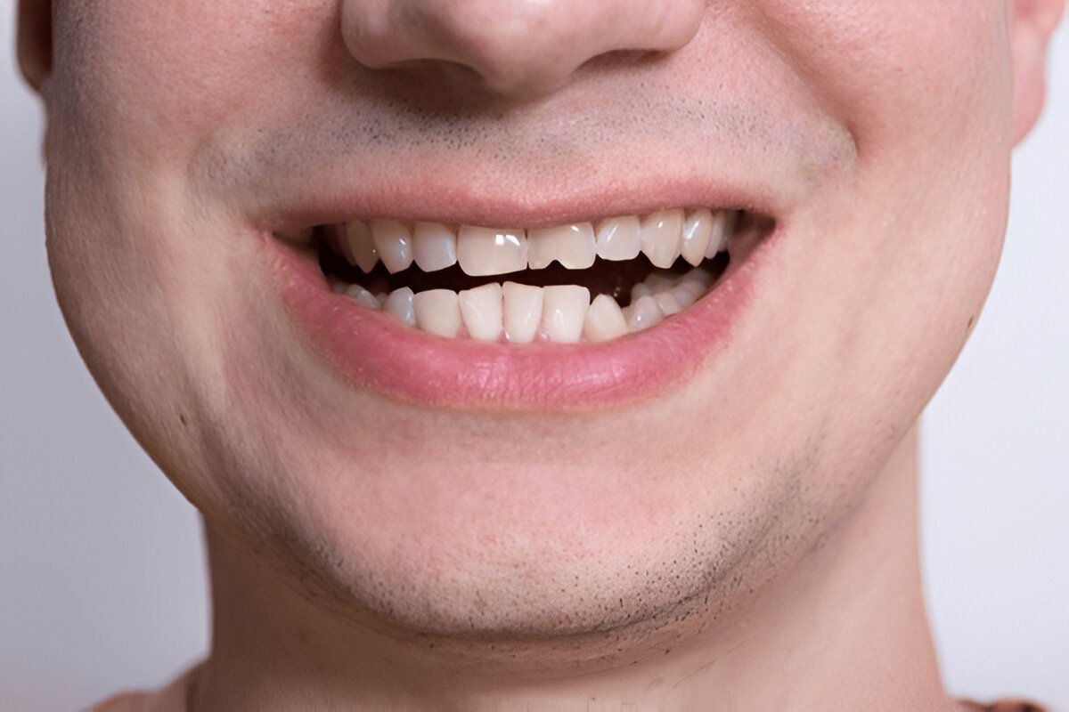 chipped tooth treatment near you