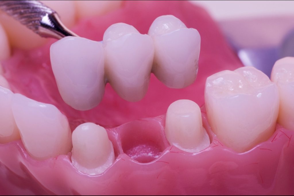dental bridges in Coquitlam
