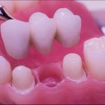 dental bridges in Coquitlam