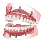 teeth in a day in coquitlam