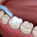 dental fillings