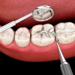 tooth fillings
